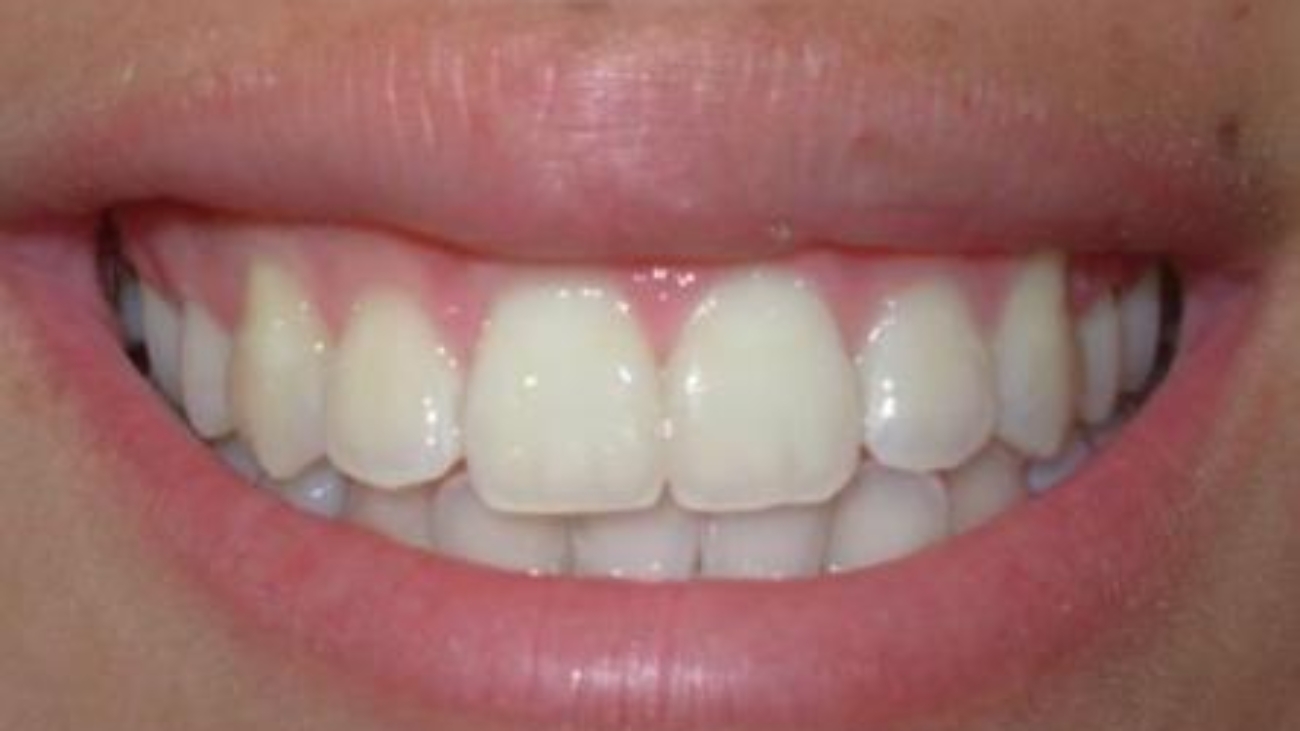 estética de las encías

contorno gingival

armonía de la sonrisa

sonrisa gingival

recesión gingival