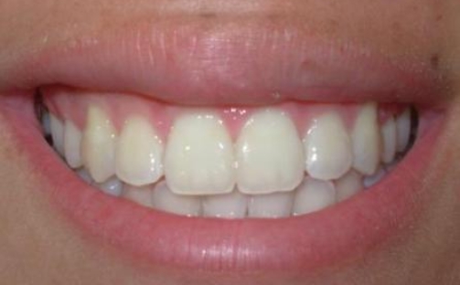 estética de las encías

contorno gingival

armonía de la sonrisa

sonrisa gingival

recesión gingival