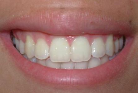 estética de las encías

contorno gingival

armonía de la sonrisa

sonrisa gingival

recesión gingival