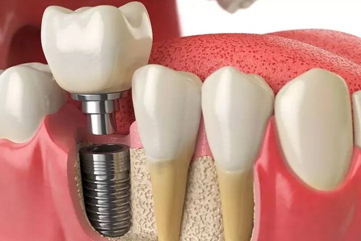 RICHSA_Implantes-Caracteristicas-y-Ventajas