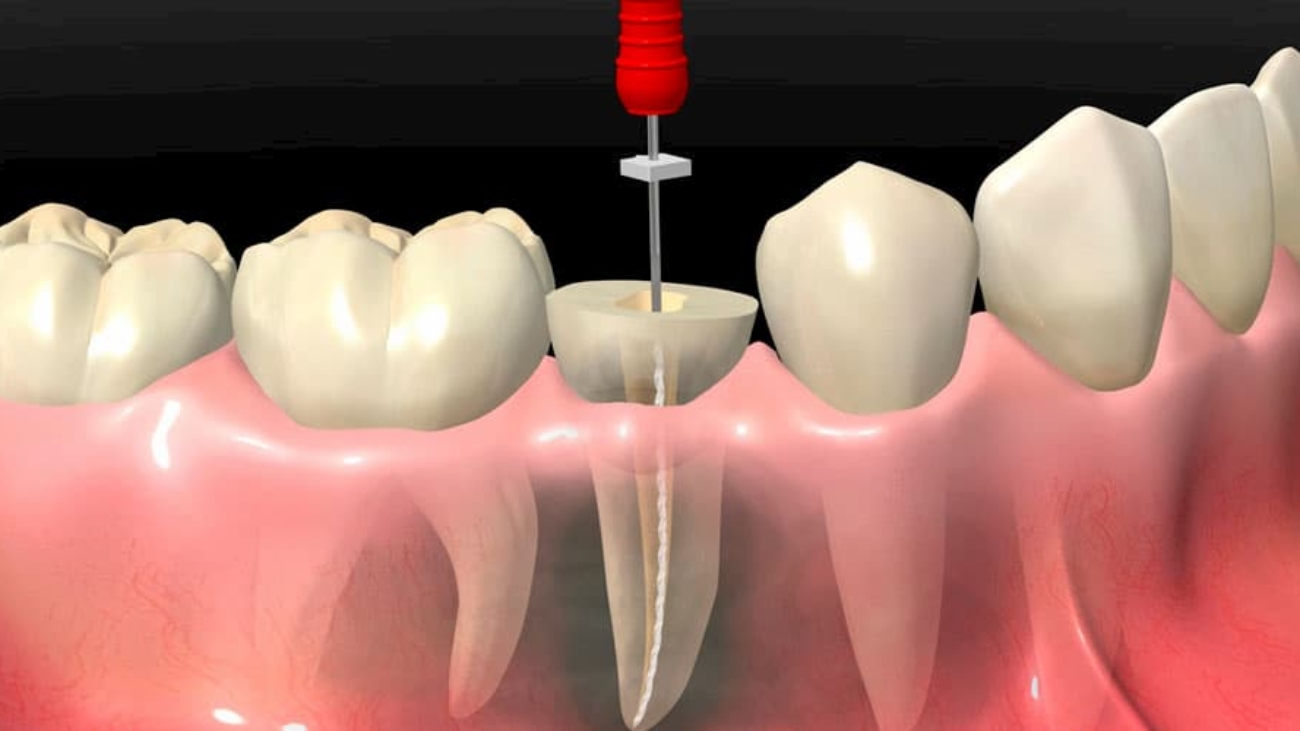 RICHSA_qué _es_endodoncia