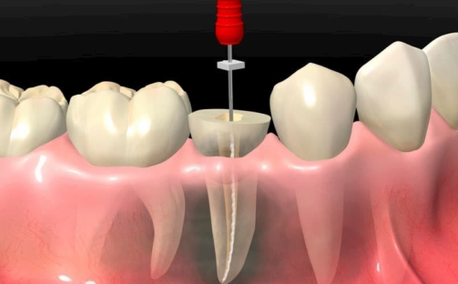 RICHSA_qué _es_endodoncia