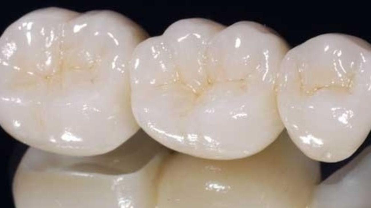 implantes inmediatos, implantología moderna, colocación inmediata, extracción e implante el mismo día, integración ósea, cirugía de implantes, corona provisional, planificación digital, estabilidad primaria, estética dental, rehabilitación con implantes, injerto de encía, osteointegración, implantología estética, éxito de implantes, dientes anteriores, colocación postextracción, tratamiento dental avanzado, implantología guiada, salud oral.