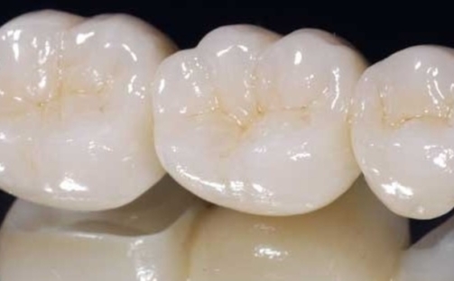 implantes inmediatos, implantología moderna, colocación inmediata, extracción e implante el mismo día, integración ósea, cirugía de implantes, corona provisional, planificación digital, estabilidad primaria, estética dental, rehabilitación con implantes, injerto de encía, osteointegración, implantología estética, éxito de implantes, dientes anteriores, colocación postextracción, tratamiento dental avanzado, implantología guiada, salud oral.